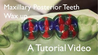 Maxillary posterior teeth  Wax up [upl. by Anatolio]