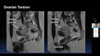 MRI of Acute Gynecologic Conditions  20 min lecture by Dr Victoria Chernyak [upl. by Noraa151]