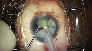 Phaco in Intumescent cataract [upl. by Trager]