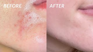 How I COMPLETELY got rid of my PERIORAL DERMATITIS in 4 DAYS the secret cure [upl. by Bertila476]