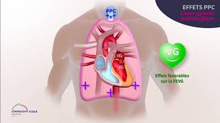 • Chapitre 5  ICP – La ventilation en PPC chez le sujet apnéique obstructif avec cardiopathie [upl. by Beauchamp]