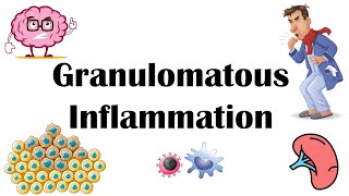 Granulomatous Inflammation  Types Pathophysiology Different Cell Types In Granuloma amp Examples [upl. by Ayotl]