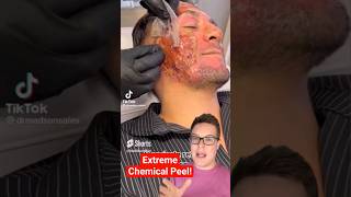 Shocking CHEMICAL PEEL  Next Level Phenol Peel shorts [upl. by Gerge]