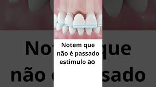 PRÓTESE FIXA OU IMPLANTE DENTÁRIO [upl. by Llezom]