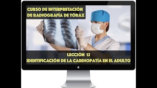 CURSO DE INTERPRETACIÓN DE LA RADIOGRAFÍA TORÁCICA IDENTIFICACIÓN DE CARDIOPATÍAS [upl. by Rebekkah346]