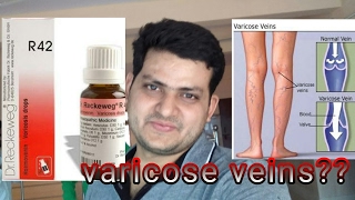 Homeopathic medicine for varicose veins explain [upl. by Galatea]