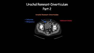 Urachal RemnantDiverticulum Part 2 radiology radiologist embryology urinarybladder [upl. by Tilden]