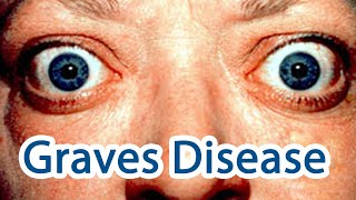 Graves disease  Explained Easy Symptoms causes mechanism treatment [upl. by Giuditta957]