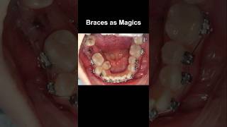 Braces as magics fix all problem braces orthodontist dentist dentistry [upl. by Nosnaj815]