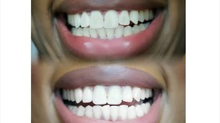 How I Whiten My Teeth  Bentonite Clay  White with Style [upl. by Aikemot]