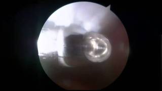 Osteochondritis Dissecans Knee Operation [upl. by Yentuoc]