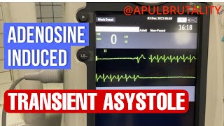 Adenosineinduced transient asystole during SVT treatment [upl. by Nemzzaj515]