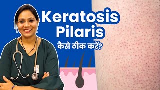 Keratosis Pilaris Treatment in Hindi  Keratosis Pilaris को कैसे ठीक करें [upl. by Ivy]