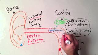 Types of Ear Infections [upl. by Ahsitaf723]