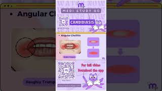 Angular Cheilitis  Oral Medicine  Medi Study Go [upl. by Aihsoem]